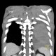 Stab wound of the thorax, perforation of the ascending aorta, bleeding into mediastinum, hemothorax: CT - Computed tomography