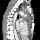 Stab wound of the thorax, perforation of the ascending aorta, bleeding into mediastinum, hemothorax: CT - Computed tomography