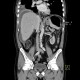 Perforation of peptic ulcer: CT - Computed tomography