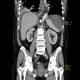 Perforation of peptic ulcer: CT - Computed tomography