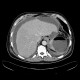Perforation of peptic ulcer: CT - Computed tomography