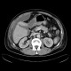 Perforation of peptic ulcer: CT - Computed tomography
