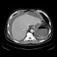 Perforation of peptic ulcer: CT - Computed tomography