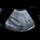 Steatofibrosis or fibrosis of the liver: US - Ultrasound