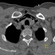 Strangulation, suicidal attempt, emphysema of neck: CT - Computed tomography