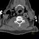Strangulation, suicidal attempt, emphysema of neck: CT - Computed tomography