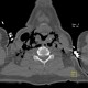 Strangulation, suicidal attempt, emphysema of neck: CT - Computed tomography