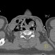 Strangulation, suicidal attempt, emphysema of neck: CT - Computed tomography