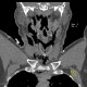 Strangulation, suicidal attempt, emphysema of neck: CT - Computed tomography