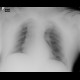 Lipofibroma, subcutaneous: X-ray - Plain radiograph
