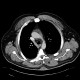 Lipofibroma, subcutaneous: CT - Computed tomography