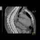 Lipofibroma, subcutaneous: CT - Computed tomography