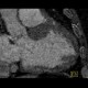 Subendocardial infarct of posterior wall of the left ventricle: CT - Computed tomography