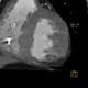 Subendocardial infarct of posterior wall of the left ventricle: CT - Computed tomography