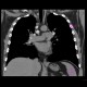 Sarcoidosis, pulmonary: CT - Computed tomography
