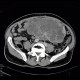 Retroperitoneal sarcoma, sarcoma of retroperitoneum, biopsy, CT guided biopsy: CT - Computed tomography