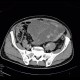Retroperitoneal sarcoma, sarcoma of retroperitoneum, biopsy, CT guided biopsy: CT - Computed tomography