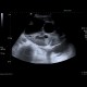 Retroperitoneal sarcoma, sarcoma of retroperitoneum, biopsy, CT guided biopsy: US - Ultrasound