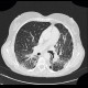 Sarcoidosis, pulmonary sarcoidosis, stage IV: CT - Computed tomography