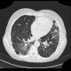 Sarcoidosis, pulmonary sarcoidosis, stage IV: CT - Computed tomography