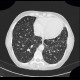 Sarcoidosis, pulmonary sarcoidosis, stage IV: CT - Computed tomography