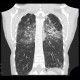 Sarcoidosis, pulmonary sarcoidosis, stage IV: CT - Computed tomography