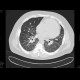 Sarcoidosis, second stage: CT - Computed tomography