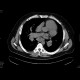 Sarcoidosis, second stage: CT - Computed tomography