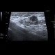 Suture granuloma, Schloffer's tumor: US - Ultrasound