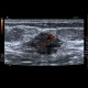 Suture granuloma, Schloffer's tumor: US - Ultrasound