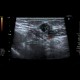 Suture granuloma, Schloffer's tumor: US - Ultrasound