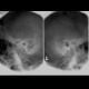 Schuller view, chronic mastoiditis: X-ray - Plain radiograph