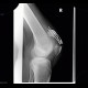 Fracture of patella, hardware failure: X-ray - Plain radiograph