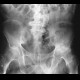 Coxarthrosis, severe: X-ray - Plain radiograph