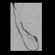 Shunt stenosis, severe, balloon angioplasty, PTA, thrombolysis: AG - Angiography