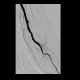 Shunt stenosis, severe, balloon angioplasty, PTA, thrombolysis: AG - Angiography