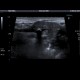 Sialolithiasis: US - Ultrasound