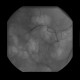 Bleeding in sigmoid colon, embolization: AG - Angiography