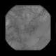 Bleeding in sigmoid colon, embolization: AG - Angiography