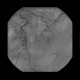 Bleeding in sigmoid colon, embolization: AG - Angiography