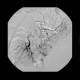 Bleeding in sigmoid colon, embolization: AG - Angiography