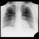 Silicosis, pulmonary silicosis: X-ray - Plain radiograph