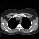 Silicosis, pulmonary silicosis: CT - Computed tomography