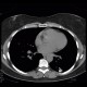 Silicosis, pulmonary silicosis: CT - Computed tomography