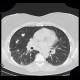 Silicosis, pulmonary silicosis: CT - Computed tomography