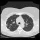 Silicosis, pulmonary silicosis: CT - Computed tomography