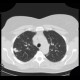 Silicosis, pulmonary silicosis: CT - Computed tomography