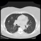 Silicosis, pulmonary silicosis: CT - Computed tomography