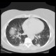 Silicosis, pulmonary silicosis: CT - Computed tomography