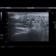 Sjogren syndrom, sialolithiasis, parotid gland: US - Ultrasound